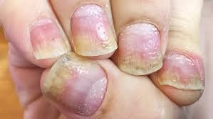 Psoriazis unghii- ce este, simptome și tratament - Bio Sculpture România