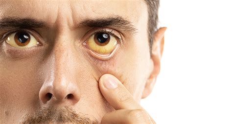 Yellow Eyes – Causes, Symptoms & Treatment