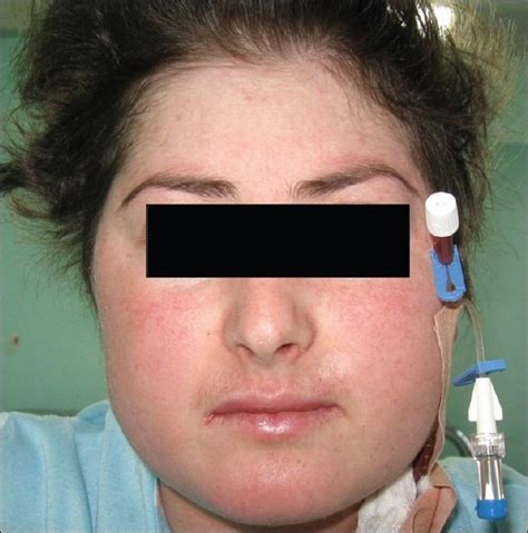 Moon facies in the second patient (Case 2) which is a typical feature ...