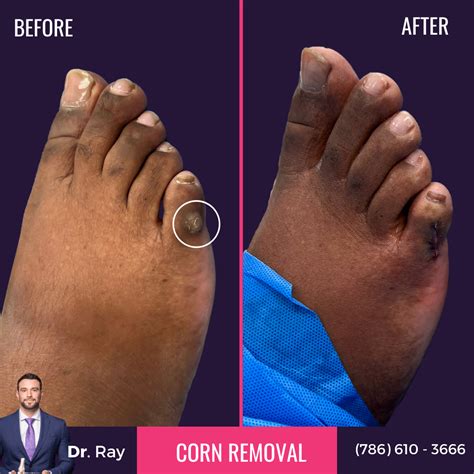 Corn Removal Surgery Miami Luxe Foot Surgery