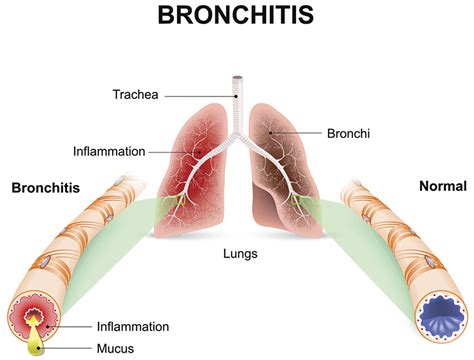 Acute and Chronic Bronchitis - Causes, Symptoms and Treatment