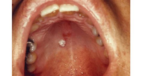 Uvula Wart