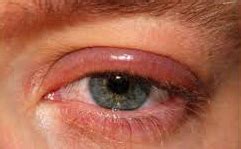 Blepharitis, Causes, Diagnosis, Treatment, Prevention, Complications - Body Health Site