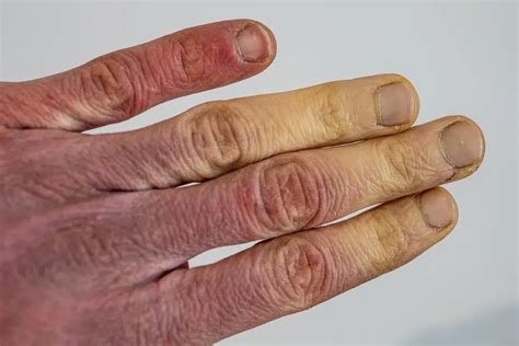 Raynaud’s Disease: Causes, Symptoms, and Management - Longmore Clinic