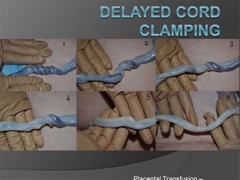 Delayed cord clamping on normally b