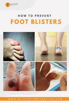 The best bister prevention strategies hone in on the blister causing ...