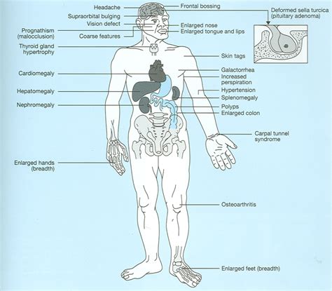 Acromegaly:Definition,Causes,Symptoms,Diagnosis,Treatment - Health