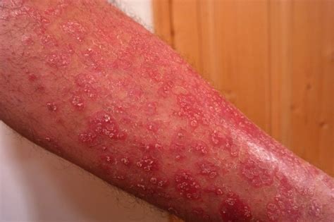 Be Aware of the Top 10 Psoriasis Triggers to Avoid – Wellness.guide