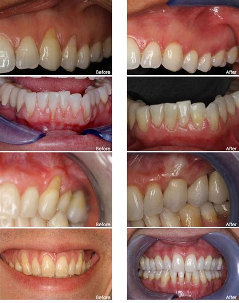 Advanced Dental Huntington Beach :: Pinhole Surgical Technique