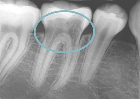 An Explanation of Tooth Resorption - Laurel Dental Clinic