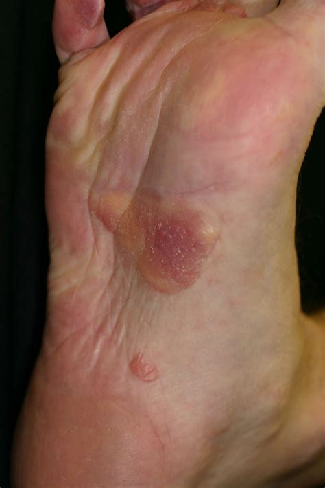 Systemic Amyloidosis with Cutaneous Manifestations (Amyloidosis ...