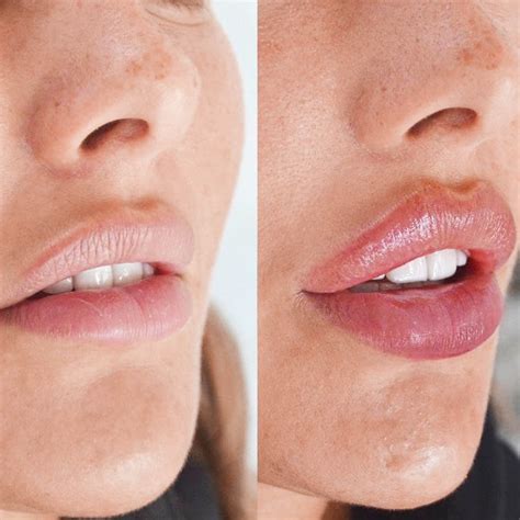 Russian Lip Filler Before & After | Skinly Aesthetics