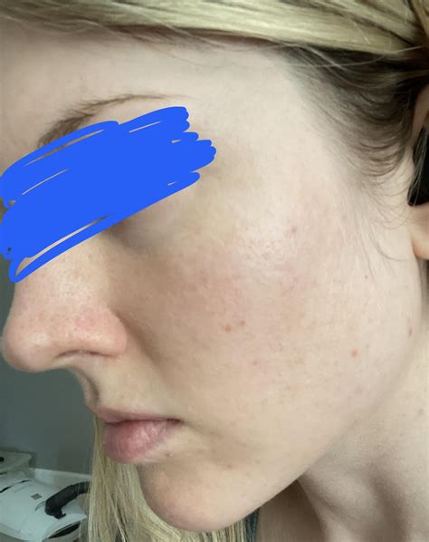 6 week before and after. Soolantra , 10% Azelaic Acid (The Ordinary). : r/Rosacea