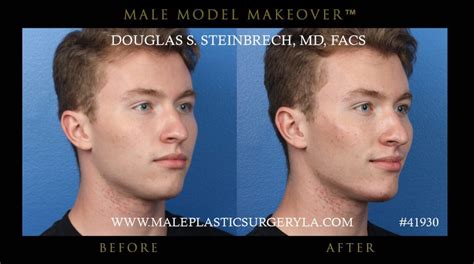 Non Surgical Face Dermal Fillers for Men