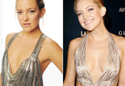 Breast Augmentation Before And After: Celebrity Edition — Atlantic Health Solutions