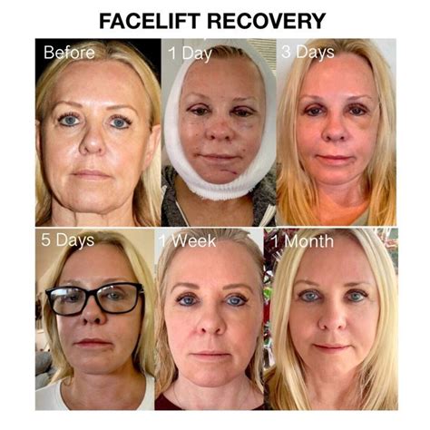 Facelift Recovery | Facelift recovery, Face lift surgery, Facelift