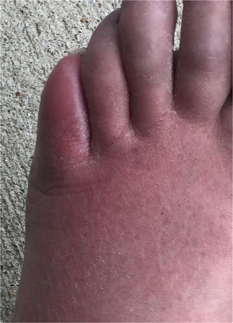 A Red, Painful, and Swollen Foot Overlying a Bone Erosion - The American Journal of Medicine