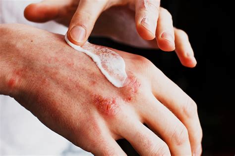 Eczema Treatments and Remedies | LifeMD