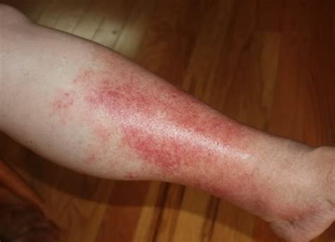 Cellulitis Skin Infection | Universal Health Care
