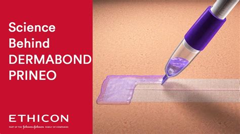 Science Behind Stronger Closure Using DERMABOND PRINEO Skin Closure System | Ethicon - YouTube