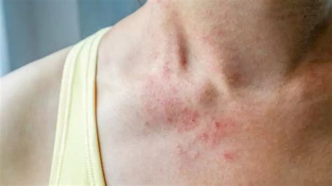 Can Dust Mites Cause Skin Rashes? - All About Dust Mites