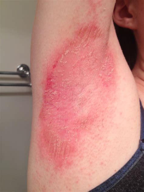 Eczema Skin Rashes On Arms | Images and Photos finder