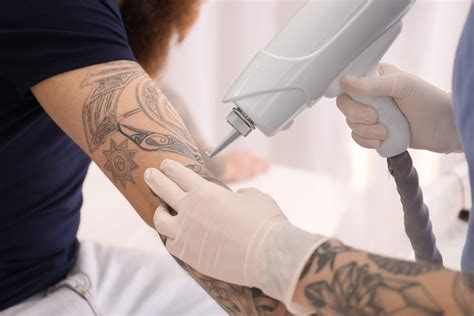 How Do Lasers Remove Tattoos?