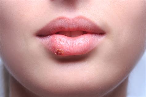 Sunburned Lips: Symptoms, Treatments, Remedies, and Prevention