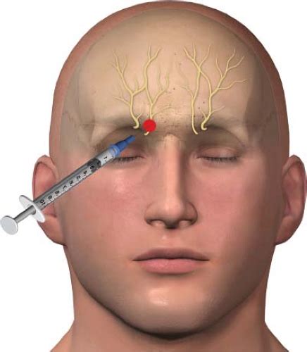 Mental Nerve Block Injection