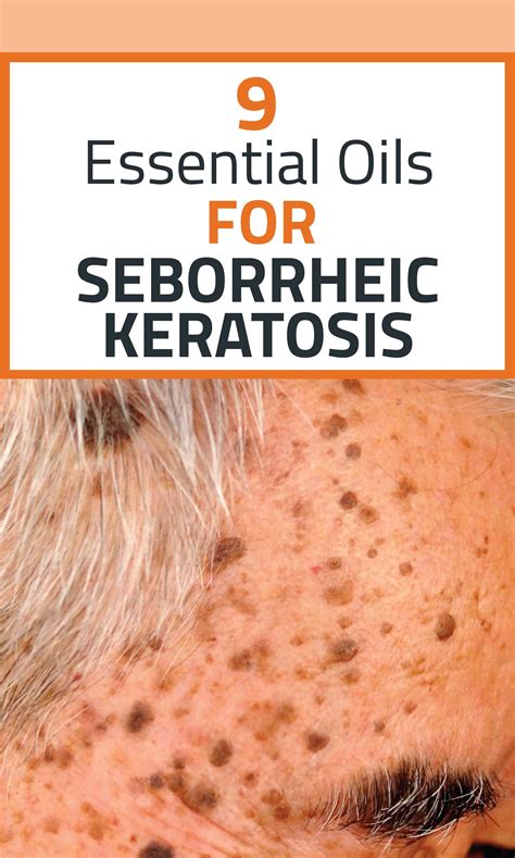 Seborrheic Keratosis Treatment Ideas In Seborrheic Keratosis | SexiezPicz Web Porn