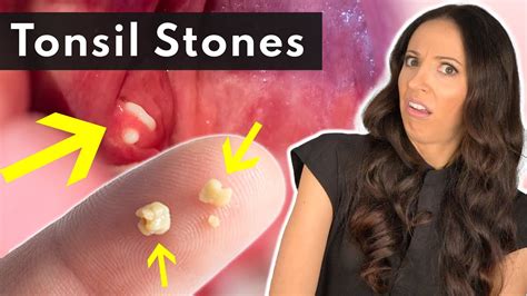 How To Get Rid Of Tonsil Stones - Creativeconversation4