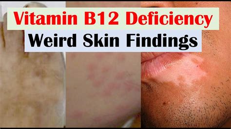 Vitamin B12 Deficiency Rash