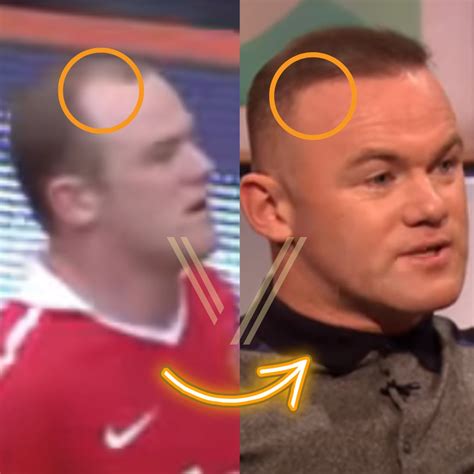 Wayne Rooney's Hair Transplant: Before and After Transformation