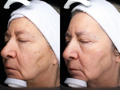 Moxi™ Laser Skin Rejuvenation for Anchorage & Wasilla | FACES Med Spa