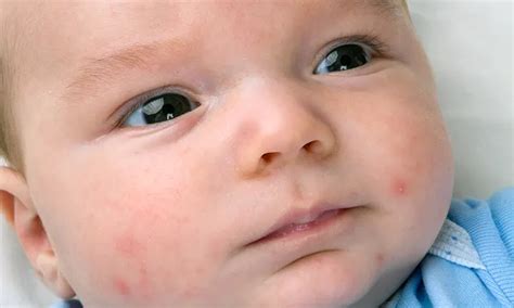 Baby Acne: What Causes It and How to Treat It | Pampers