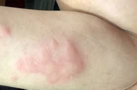 Cockroach Bite Treatment | Pestclue