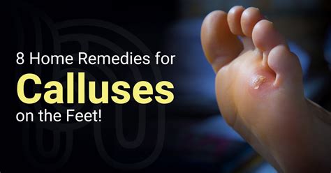 Foot Callus Remover Remedies – Foot Care Tips