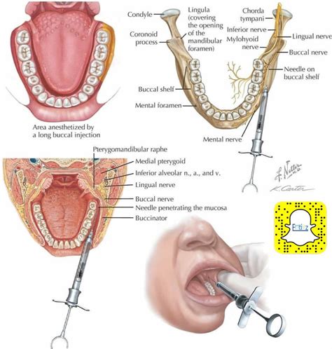 Buccal Nerve Block