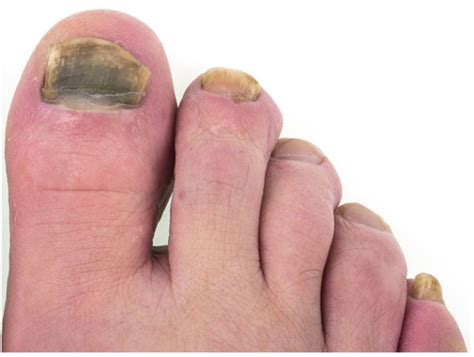 Toenail Fungus - Symptoms and Treatment Tips