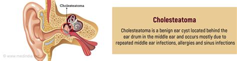 Symptoms and Signs of Cholesteatoma