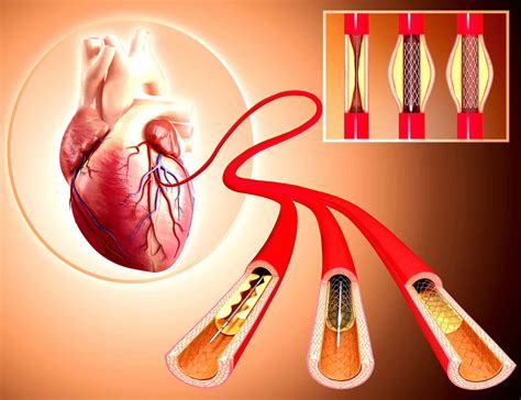 Do Angioplasty and Stents Increase Life Expectancy?