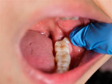 Why Wisdom Teeth Removal is Important for Dental Health - Hamilton Dental Emergency Centre