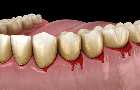 Bleeding Gums | Arkansas Periodontal and Implant Associates