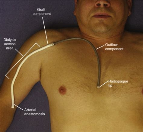 Basilic and Femoral Vein Transposition | Thoracic Key