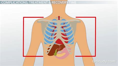 Chest Contusion: Complications, Treatment & Recovery Time - Video & Lesson Transcript | Study.com