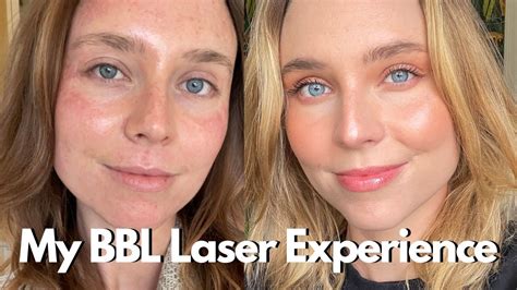 Bbl Light Treatment Before And After | Shelly Lighting