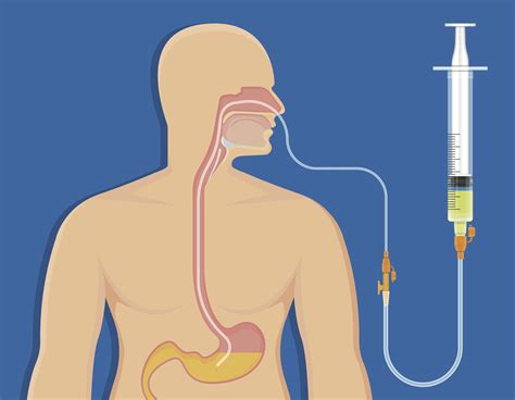 Information on Gastric Feeding Tube and Nasogastric Feeding Tube