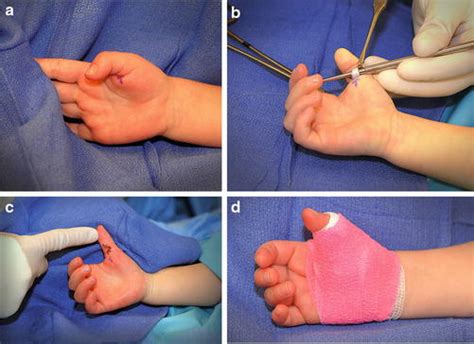 Pediatric Trigger Thumb and Finger | Obgyn Key