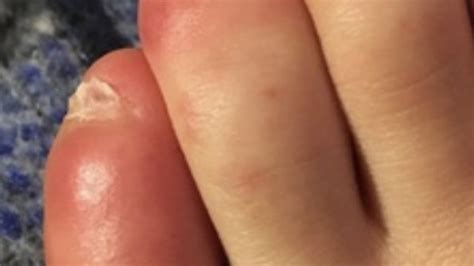 Red, swollen toes? It could be COVID-19 | ABC6