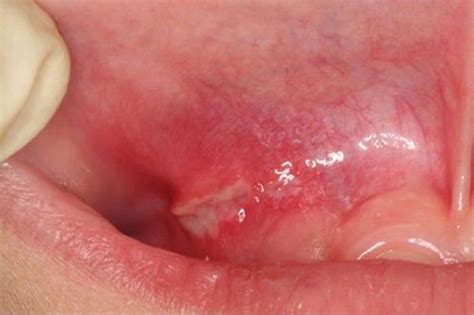 Canker Sores (Aphthous Ulcer) - Causes, Symptoms, Diagnosis | Stockton ...